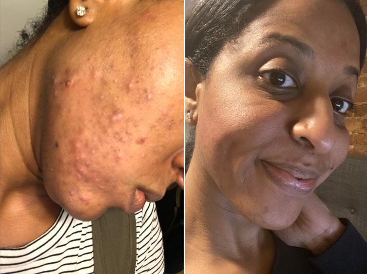 Split image with hormonal acne on left and clear skin right